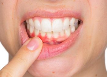 Điều bạn cần biết về bệnh viêm lợi