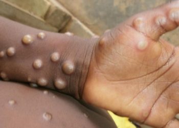 Bệnh đậu mùa khỉ đang lây lan chóng mặt nguy hiểm thế nào?