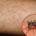 Cách phòng bệnh sốt xuất huyết trong mùa hè