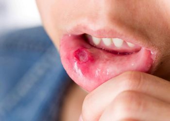 Top 7 thực phẩm giúp điều trị nhiệt miệng nhanh và hiệu quả